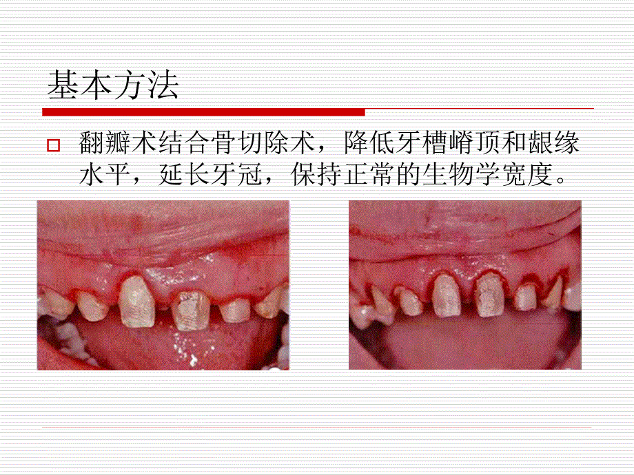 《牙冠延长术》ppt课件_第4页