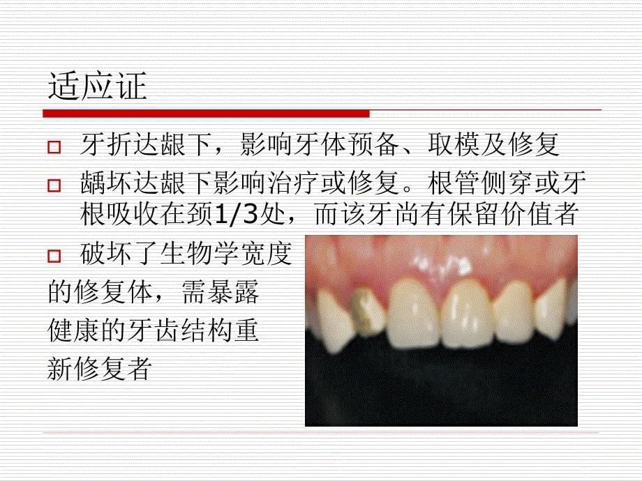 《牙冠延长术》ppt课件_第5页