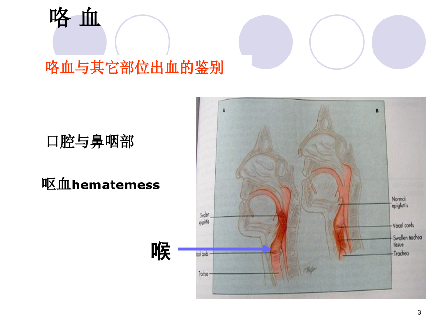 《问诊咯血》ppt课件_第3页