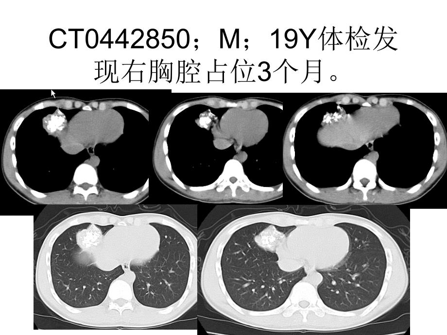 《肺部病例读片》ppt课件_第1页