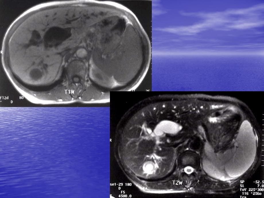 课件：ct肝脏良性肿瘤 ppt课件_第5页