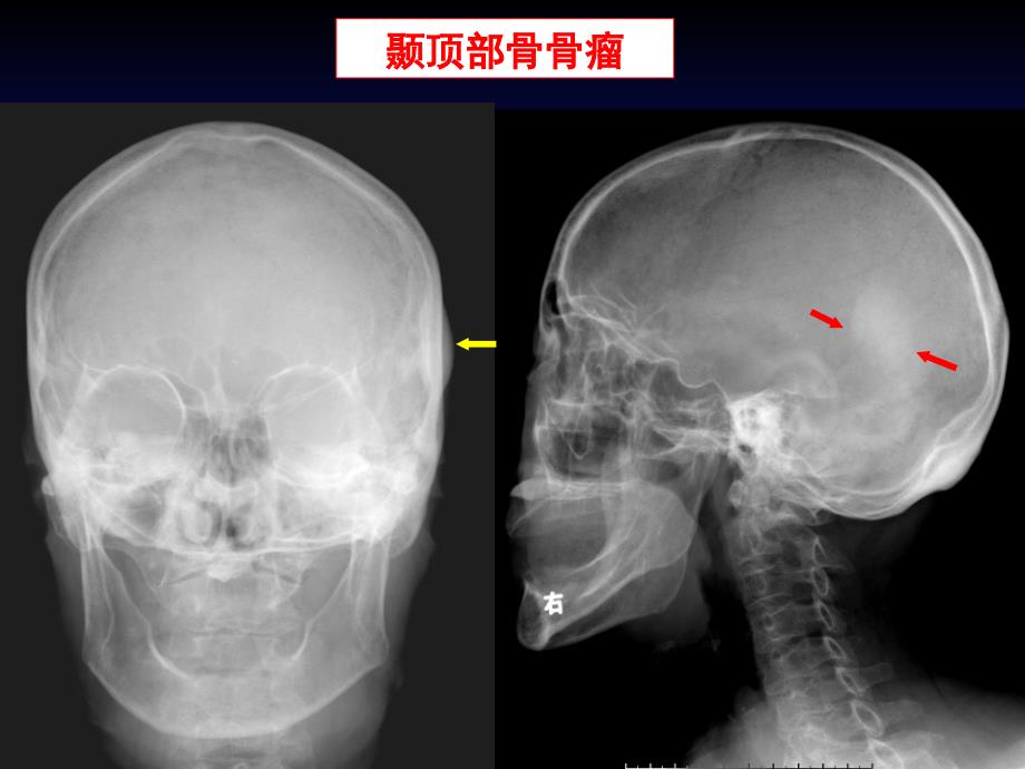 课件：骨肿瘤ct和mri的影像表现_第4页