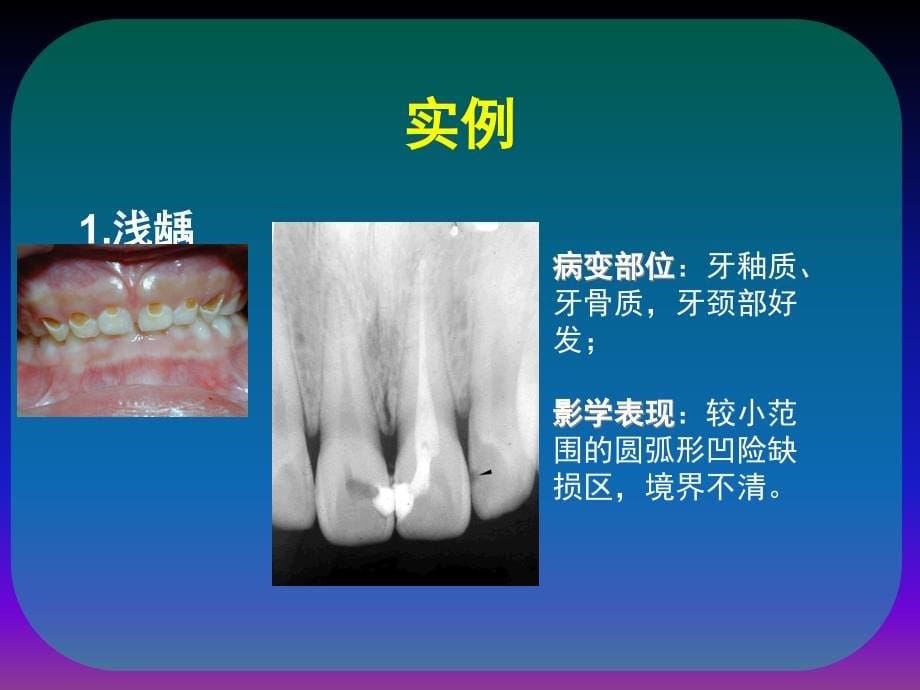 课件：影像学.牙.牙周.颌骨.肿瘤样疾病_第5页