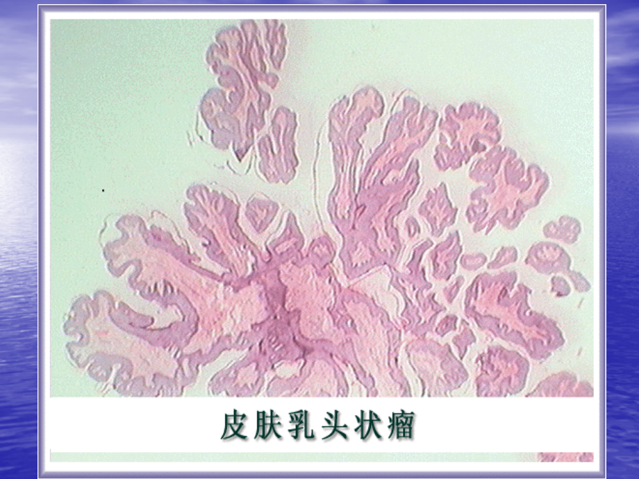 课件：胡群峰常见肿瘤举例_第4页