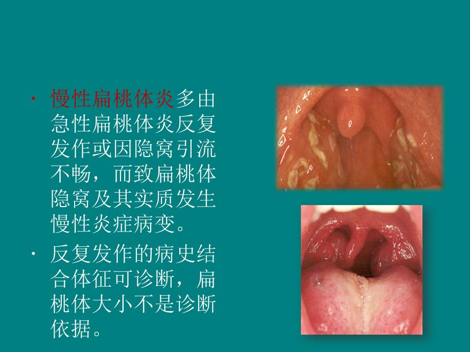 课件：扁桃体切除对iga肾病的影响_第3页