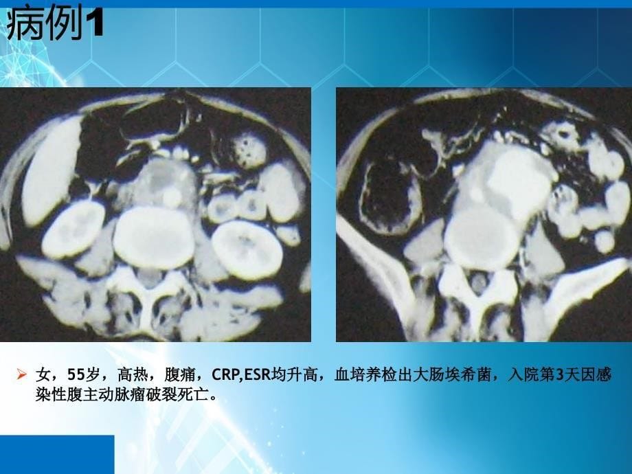 课件：感染性腹主动脉瘤诊疗体会_第5页