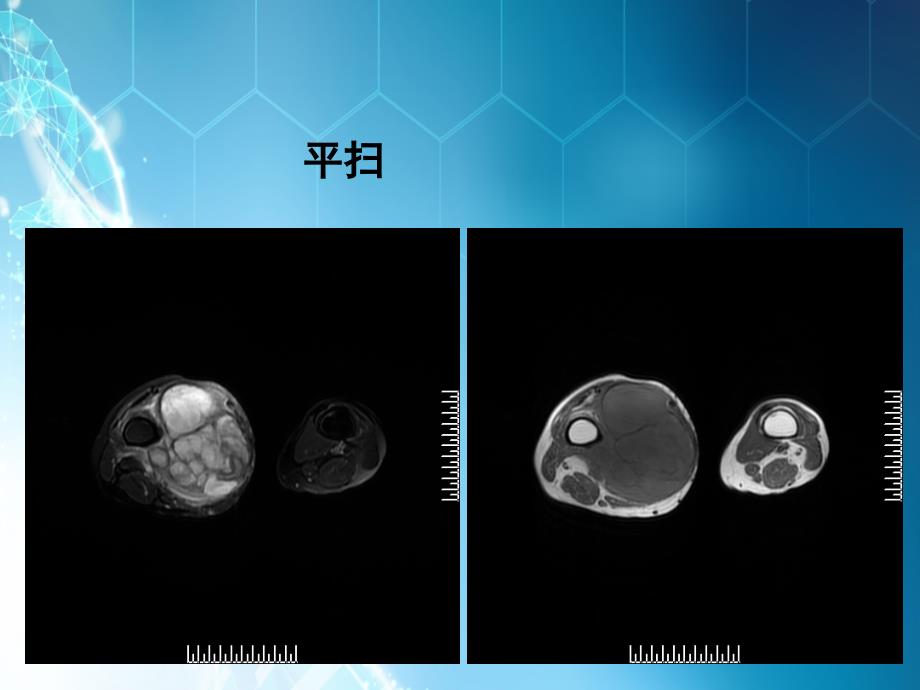 课件：脂肪肉瘤的影像诊断_第4页