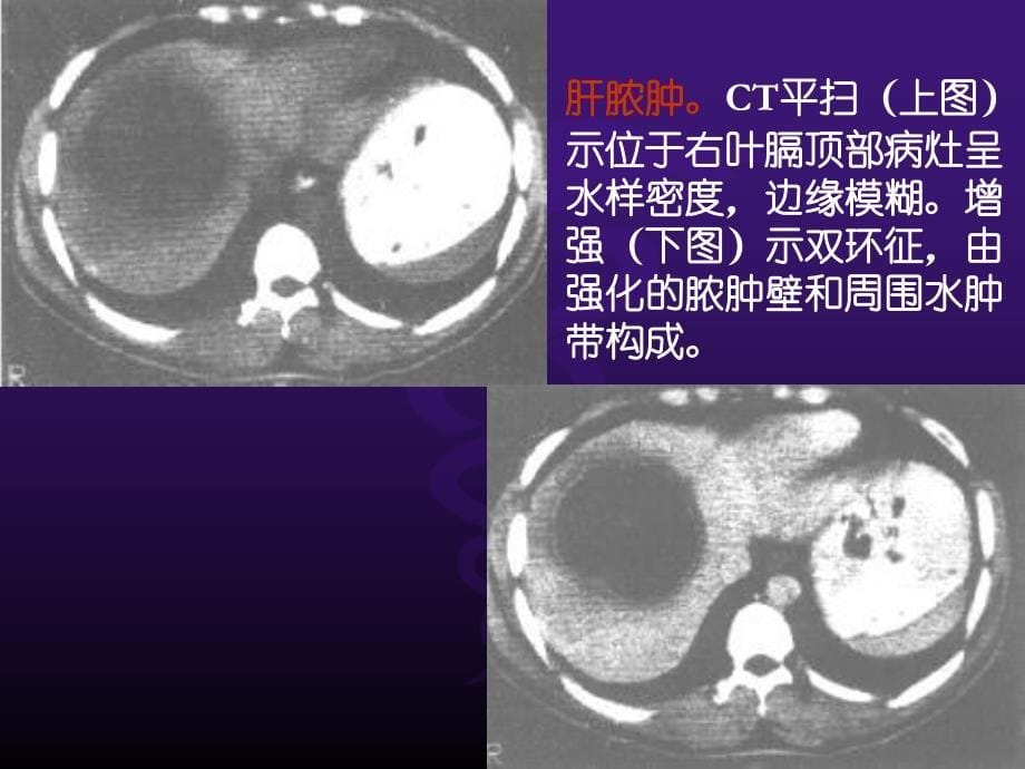 课件：ct肝脓肿及其它病变 (2)_第5页