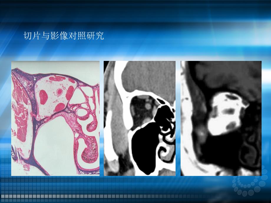 头颈部肿瘤影像诊断与鉴别ppt课件_第3页