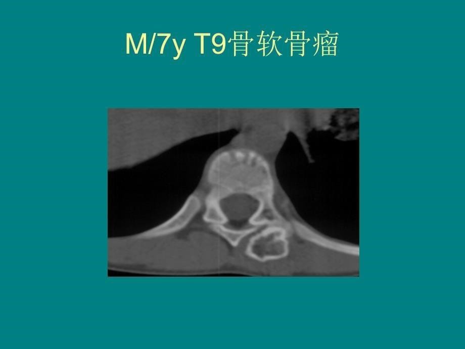 课件：脊柱软骨类肿瘤_第5页