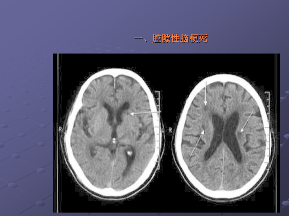 课件：颅脑疾病影像浅谈_第2页