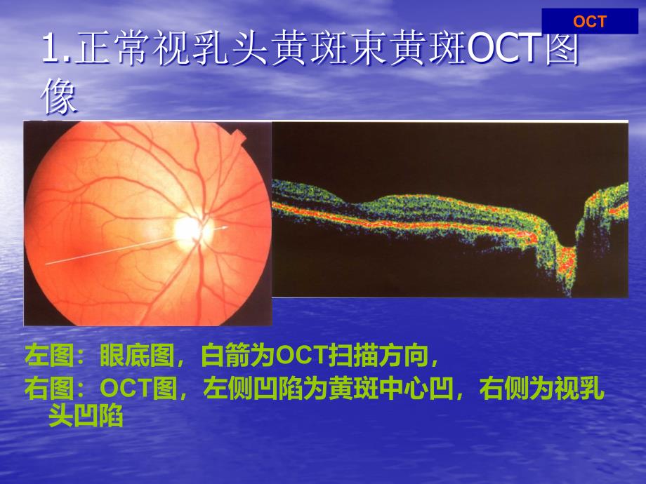 课件：oct结果解读_第2页