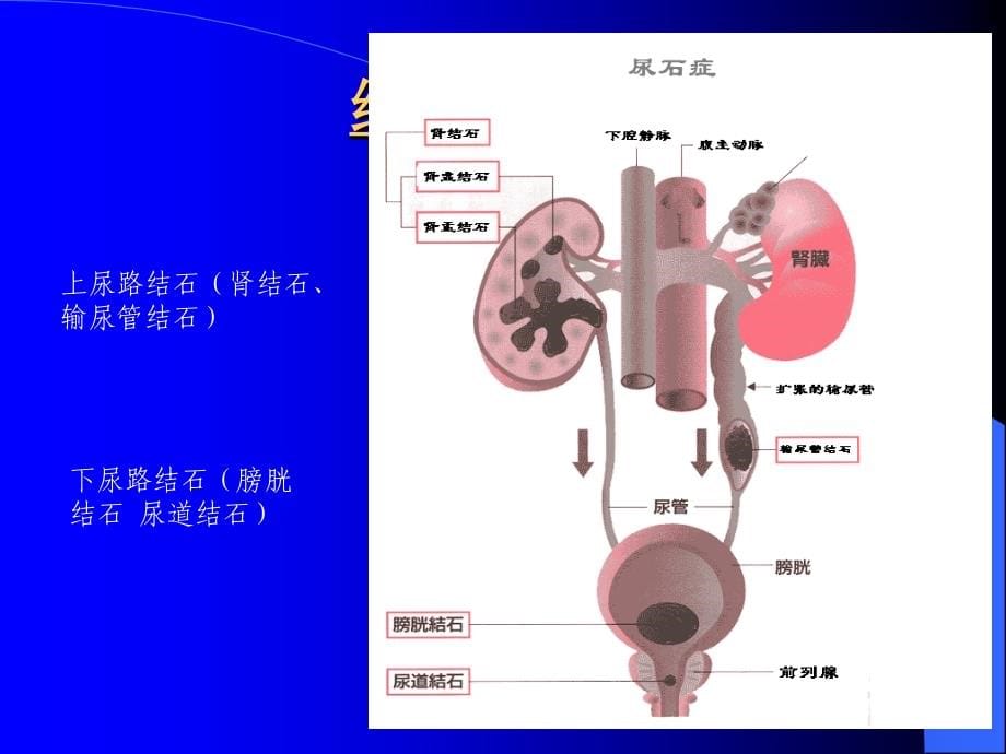 课件：泌尿系结石的诊治规范_第5页