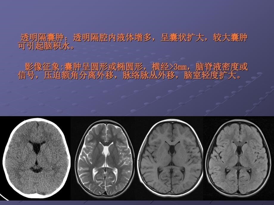 课件：颅脑先天性疾病影像诊断_第5页