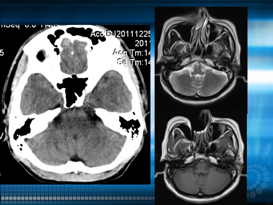 课件：头颅ct、mri疾病影像学_第3页