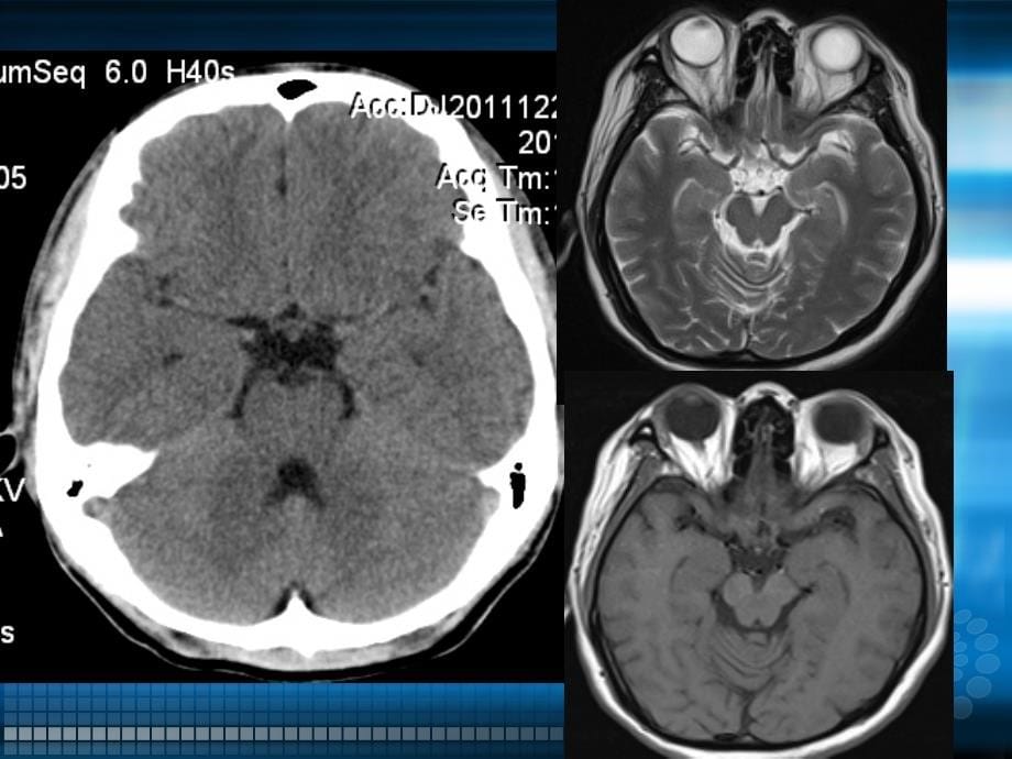 课件：头颅ct、mri疾病影像学_第5页