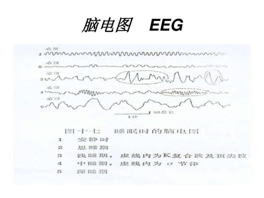 《临床脑电图解读》ppt课件_第4页