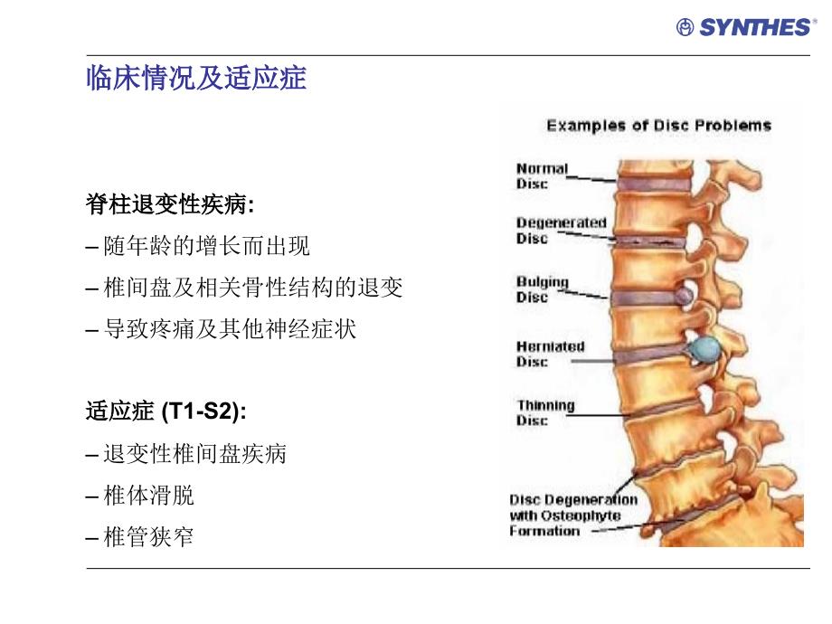 angea上开口多轴向椎弓根螺钉产品介绍_第3页