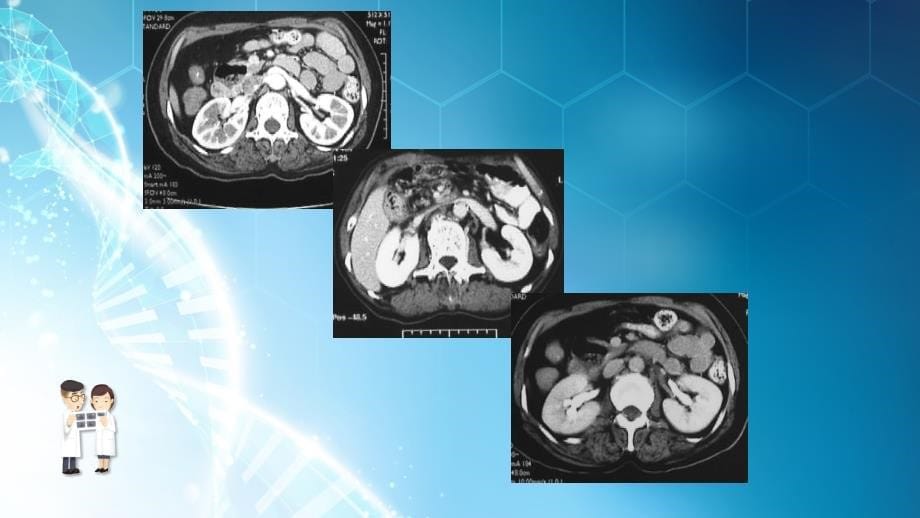 课件：腹部影像诊断-肾脏ct_第5页