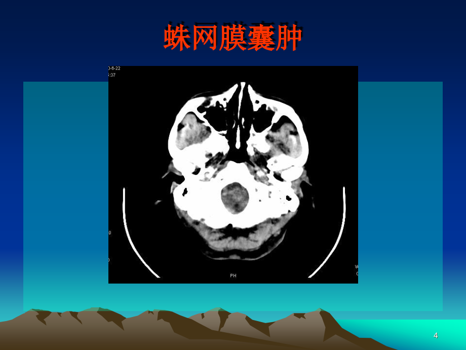 《ct、mr的临床应用》ppt课件_第4页