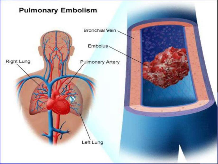 课件：肺栓塞护理查房_第4页