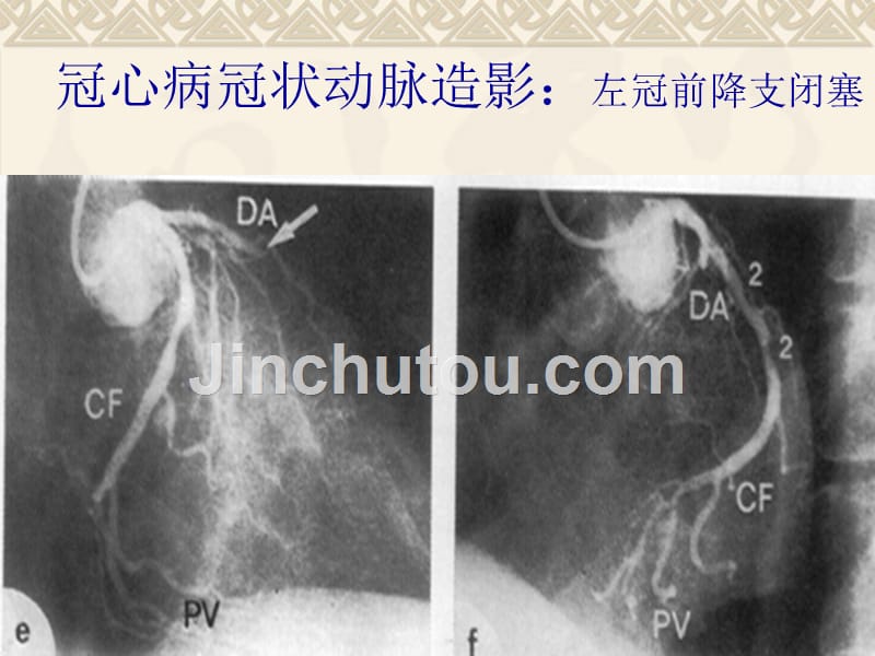 后天性心脏病的x线诊断4后心ppt课件_第5页