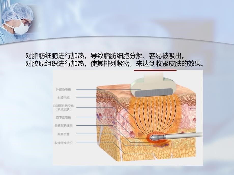 radiofrequencyassistedliposuction108ppt课件_第5页