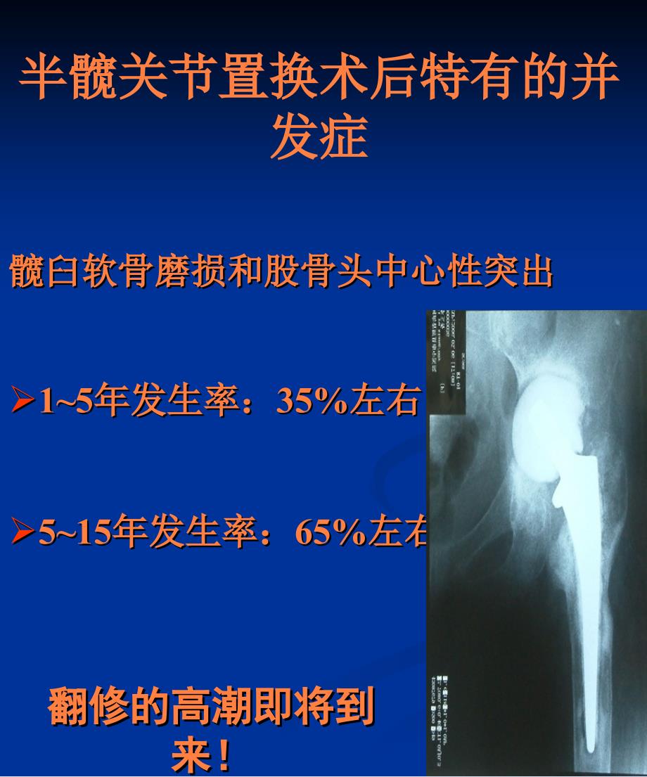 课件：髋关节假体的选择_第3页