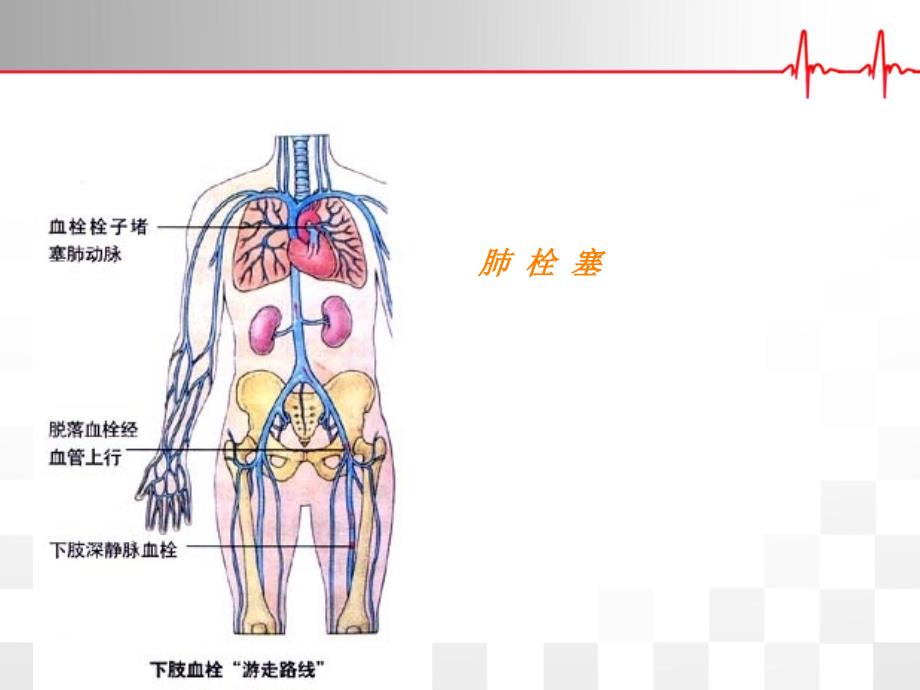 课件：肺栓塞诊疗及护理_第1页