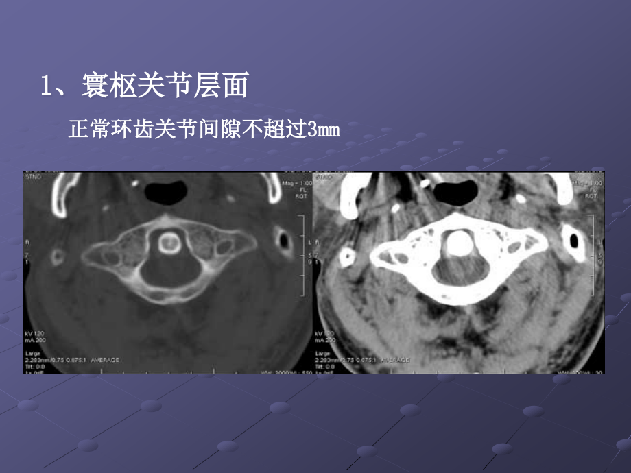 课件：颈椎和颈髓病变影像学诊断_第3页