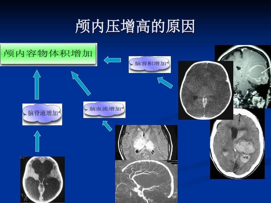 唐贝颅内压增高病人的护理_第5页