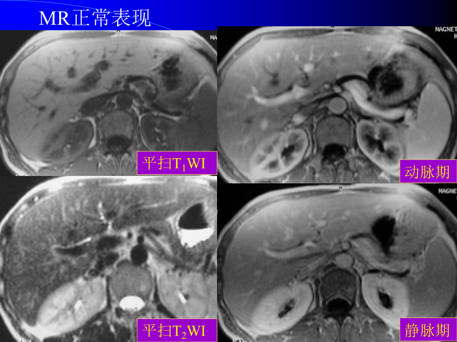 《腹部的mri诊断》ppt课件_第4页