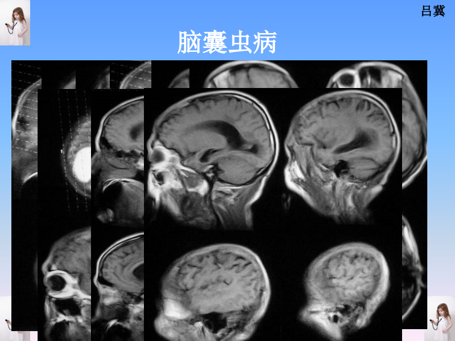 医影在线--cns疾病影像图库1_第3页