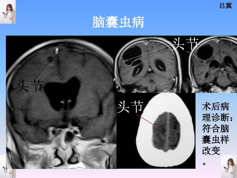 医影在线--cns疾病影像图库1_第5页