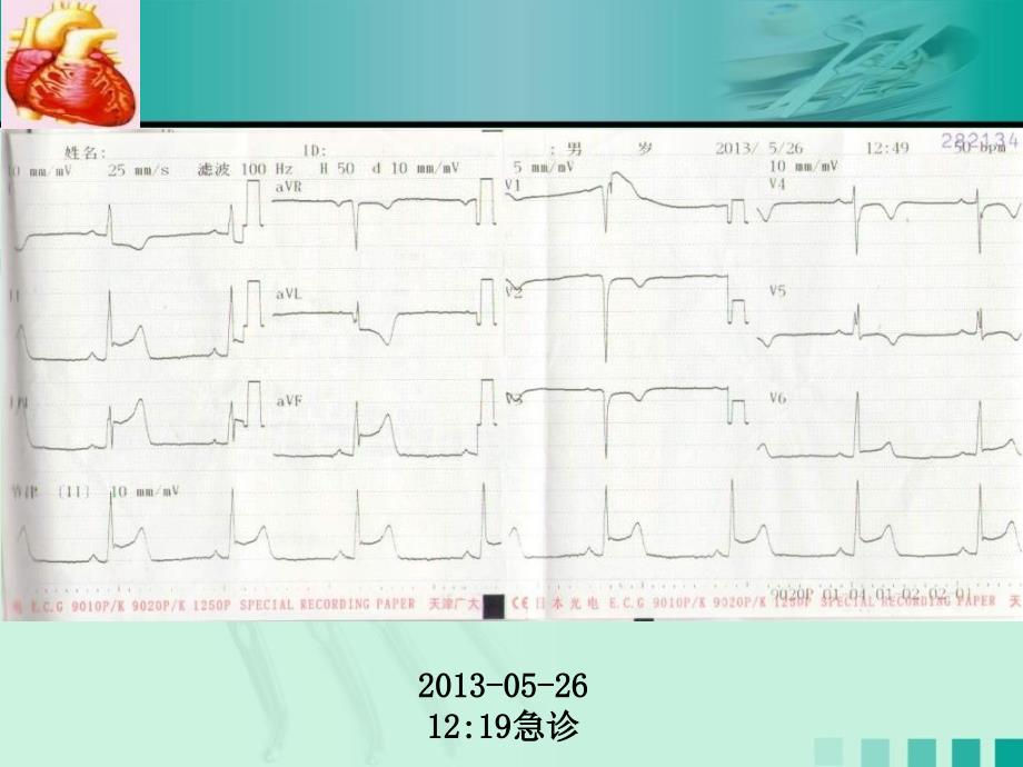 广泛前壁心肌梗死病案讨论_第4页