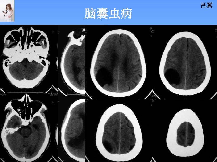 医影在线--cns疾病影像图库1_第2页