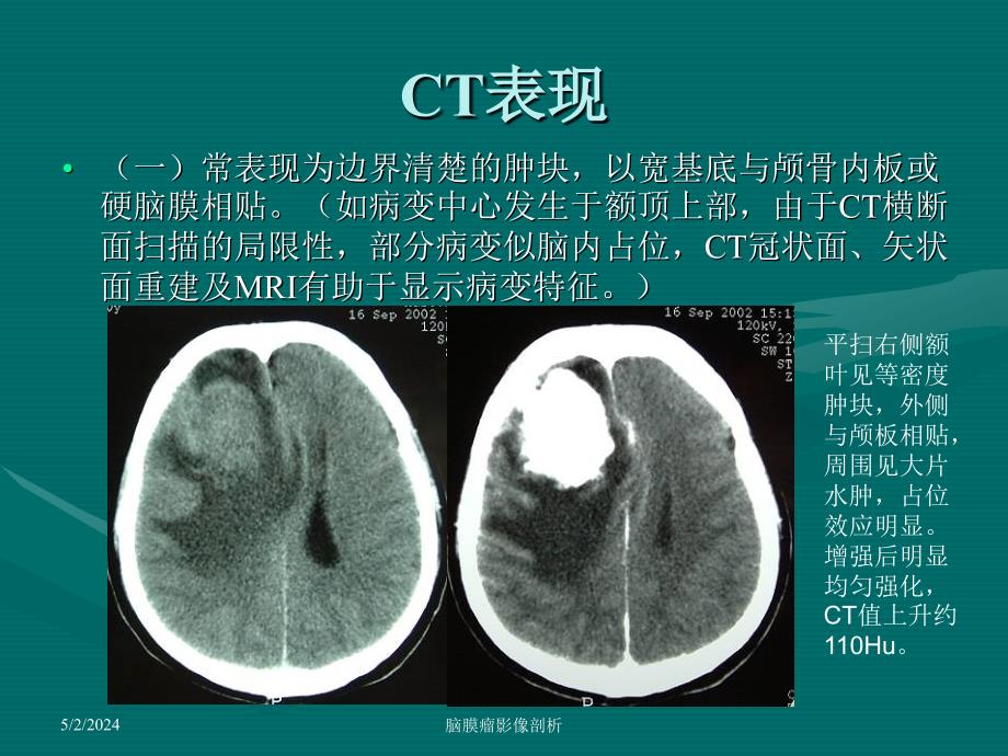 《脑膜瘤ct、mri表现》ppt课件_第3页