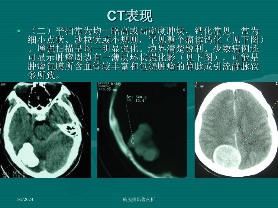 《脑膜瘤ct、mri表现》ppt课件_第4页