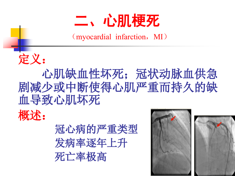 《心肌梗死课件精》ppt课件_第2页