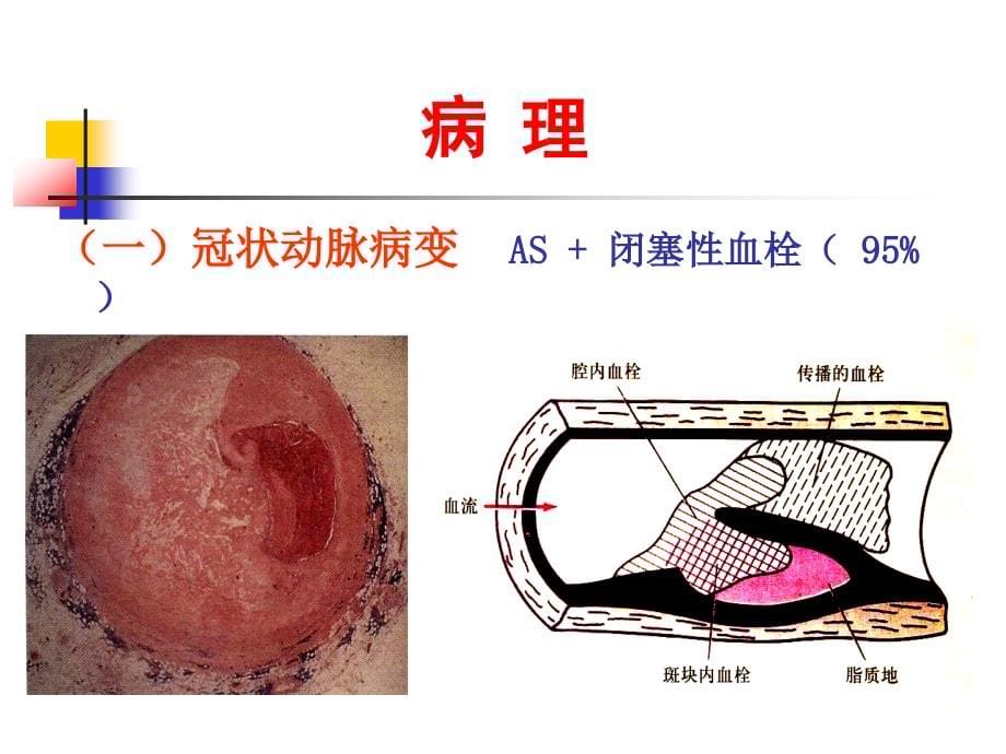 《心肌梗死课件精》ppt课件_第5页