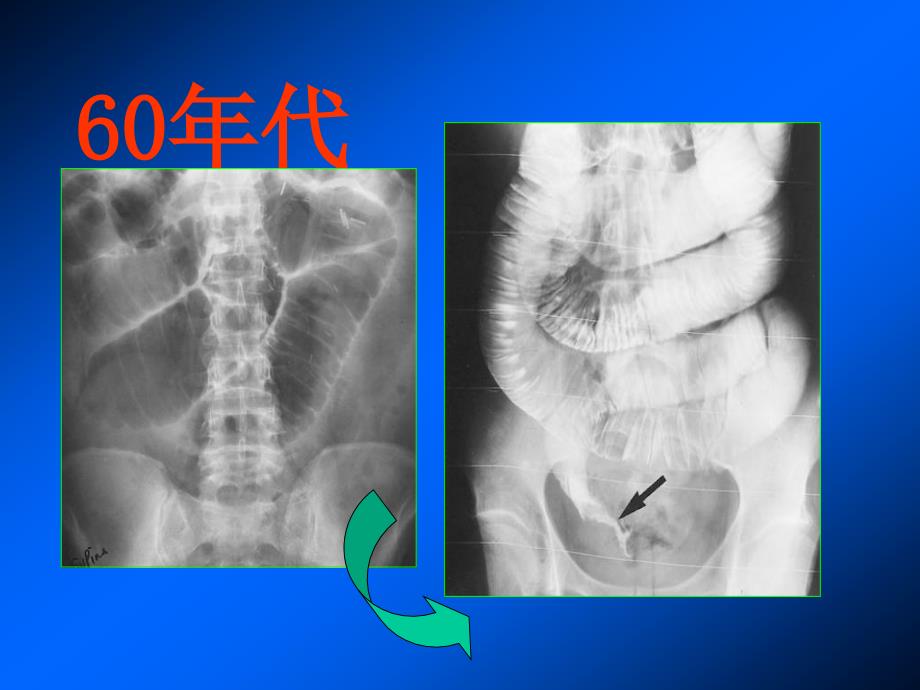 胃肠道影像检查技术的发展_第3页