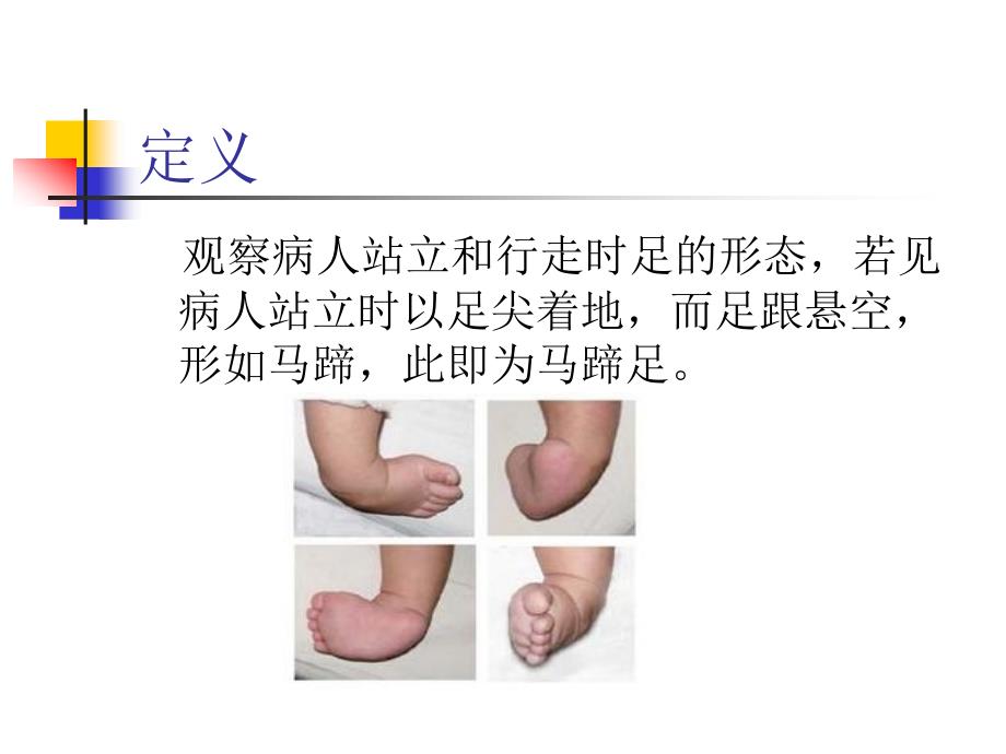 马蹄足畸形讲课ppt.ppt_第2页