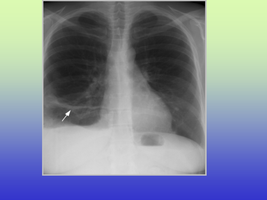 肺动脉栓塞的影像图_第3页