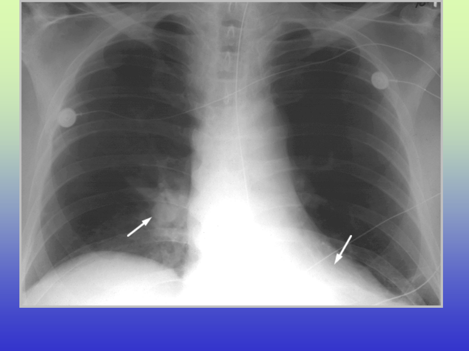 肺动脉栓塞的影像图_第4页