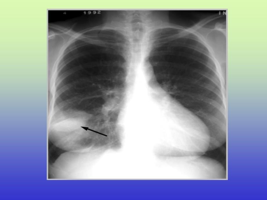 肺动脉栓塞的影像图_第5页