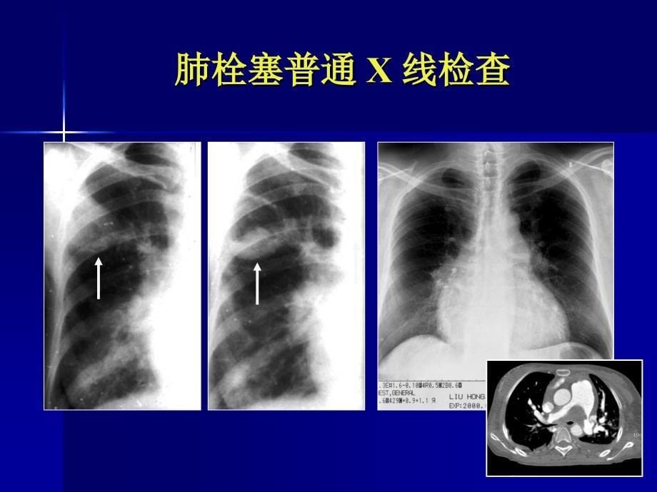 肺栓塞影像诊断及鉴别诊断_第5页