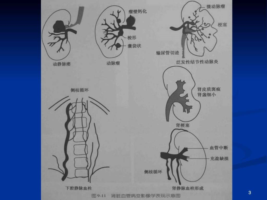 课件：下)肾脏cta影像诊断_第3页