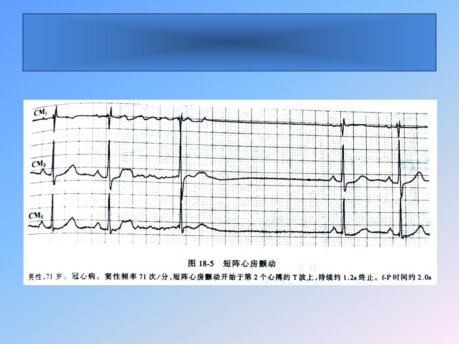 课件：心房颤动的ecg表现和治疗_第4页