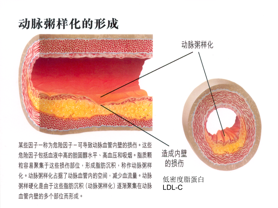 课件：如何积极预防心脑血管疾病_第4页