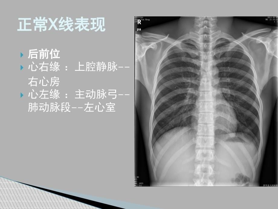 课件：心脏的基本x线表现_第5页